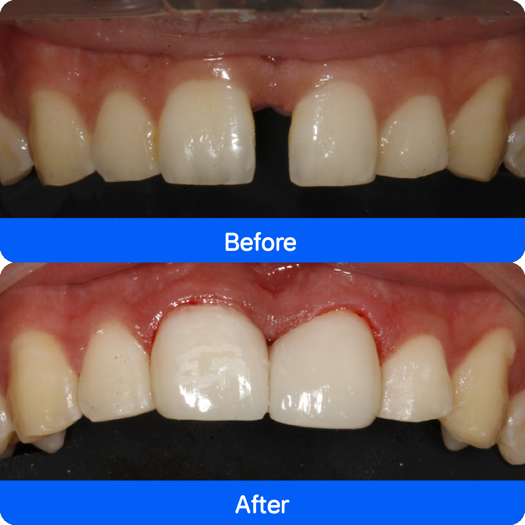 Micro / no-prep veneers in China — before and after, case 4
