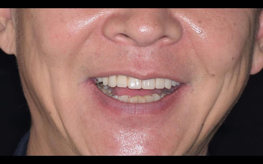 All-on-4 before and after: restored smile after full upper-arch implant treatment in China