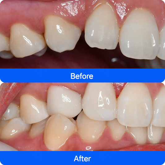 Micro / no-prep veneers in China — before and after, case 1