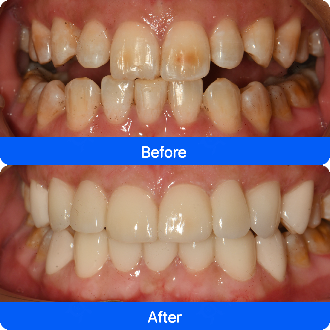 Micro / no-prep veneers in China — before and after, case 2