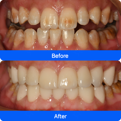 Micro / no-prep veneers in China — before and after, case 2