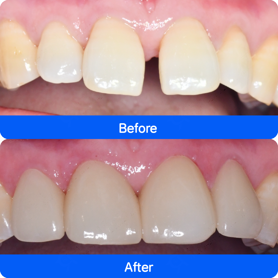 Micro / no-prep veneers in China — before and after, case 3