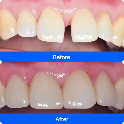 Micro / no-prep veneers in China — before and after, case 3