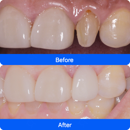 Porcelain veneers in China — before and after, case 1