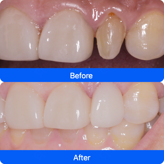 Porcelain veneers in China — before and after, case 1