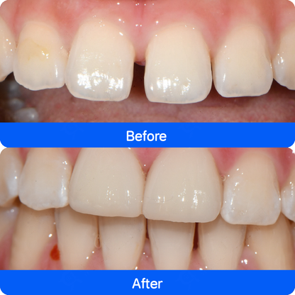 Porcelain veneers in China — before and after, case 2