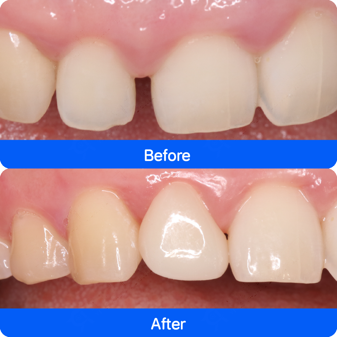 Porcelain veneers in China — before and after, case 3
