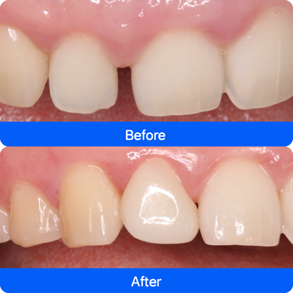 Porcelain veneers in China — before and after, case 3