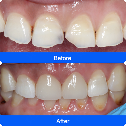Porcelain veneers in China — before and after, case 4