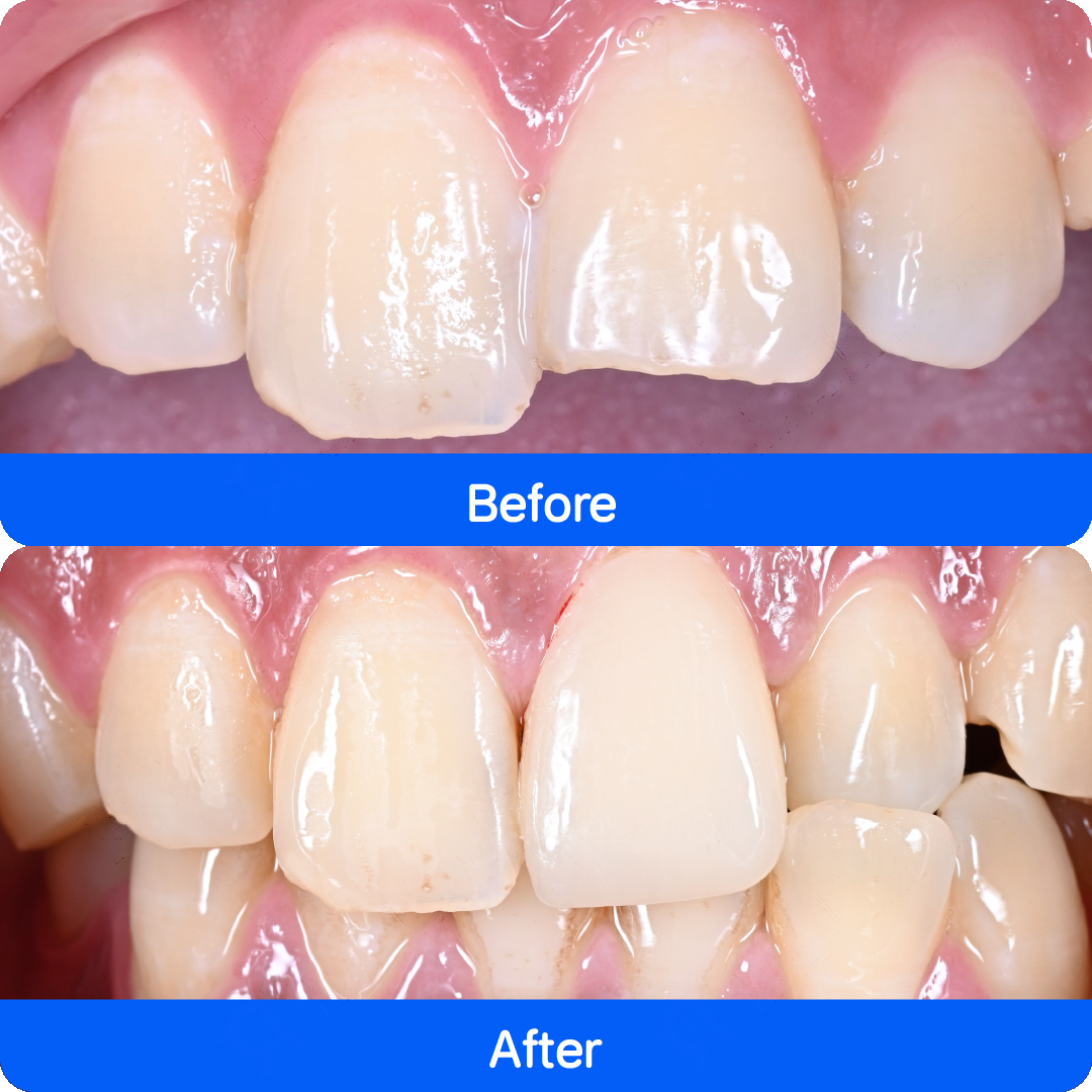 Porcelain veneers in China — before and after, case 5