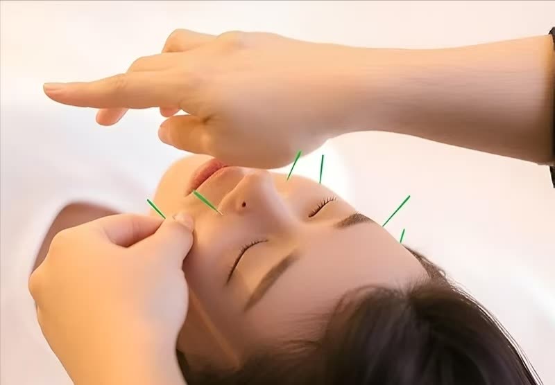 Facial acupuncture session at a hospital TCM department in Guangzhou